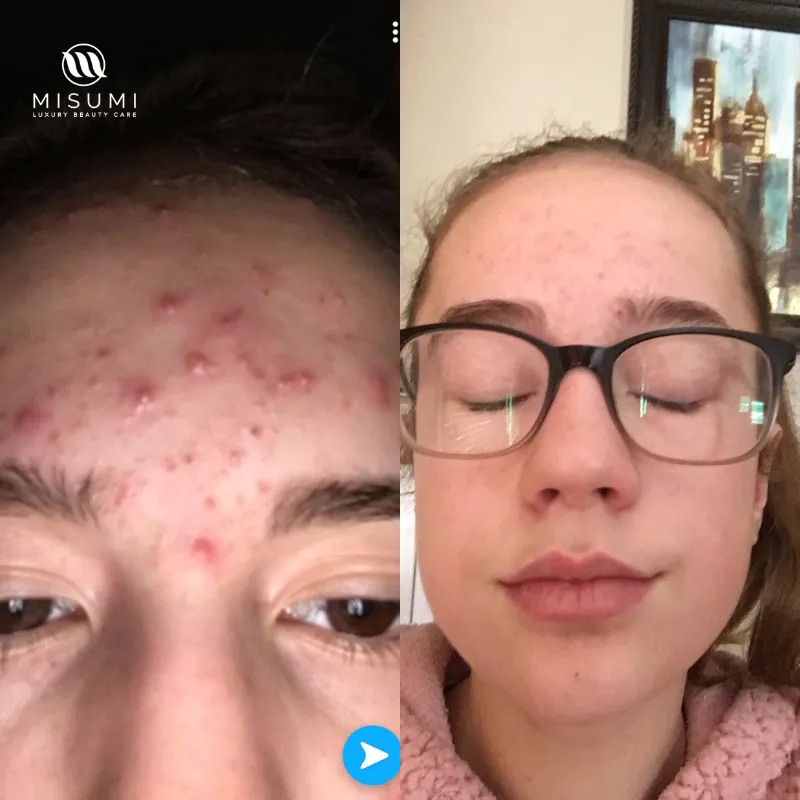 Clear Skin Duo Set